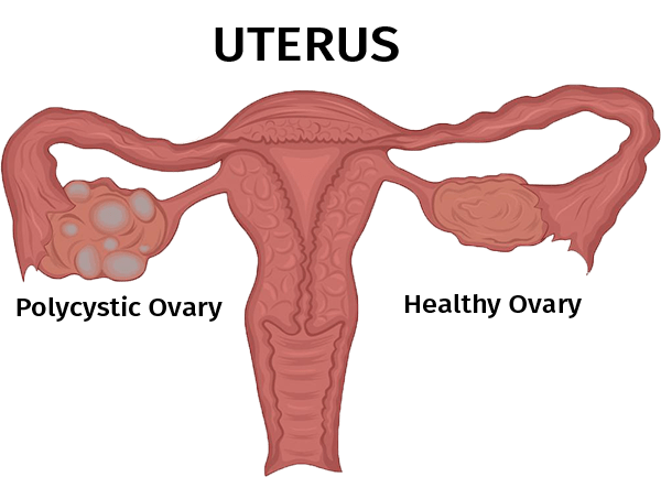 pcos, polycystic ovarian syndrome